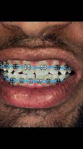 Appareil Dentaire Esthétique:Le Sourire Tendance qui Fait Craquer Tout le Monde