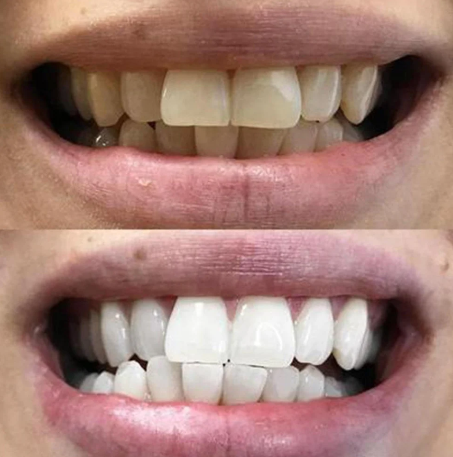 BANDES BLANCHISSANTES DENTS – SOURIRE BLANC EN 7 JOURS