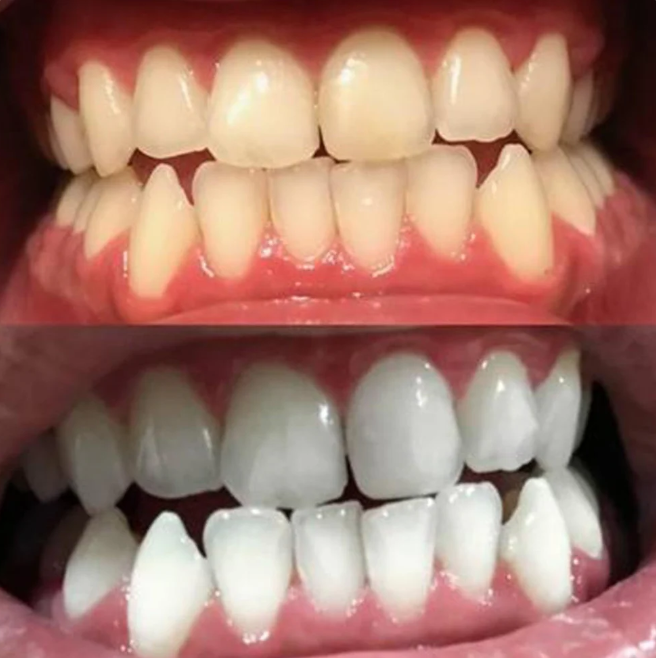 BANDES BLANCHISSANTES DENTS – SOURIRE BLANC EN 7 JOURS