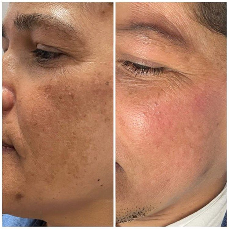 Crème Anti-Taches Mélasma & Tâches hyperpigmentaires & Éclaircissante