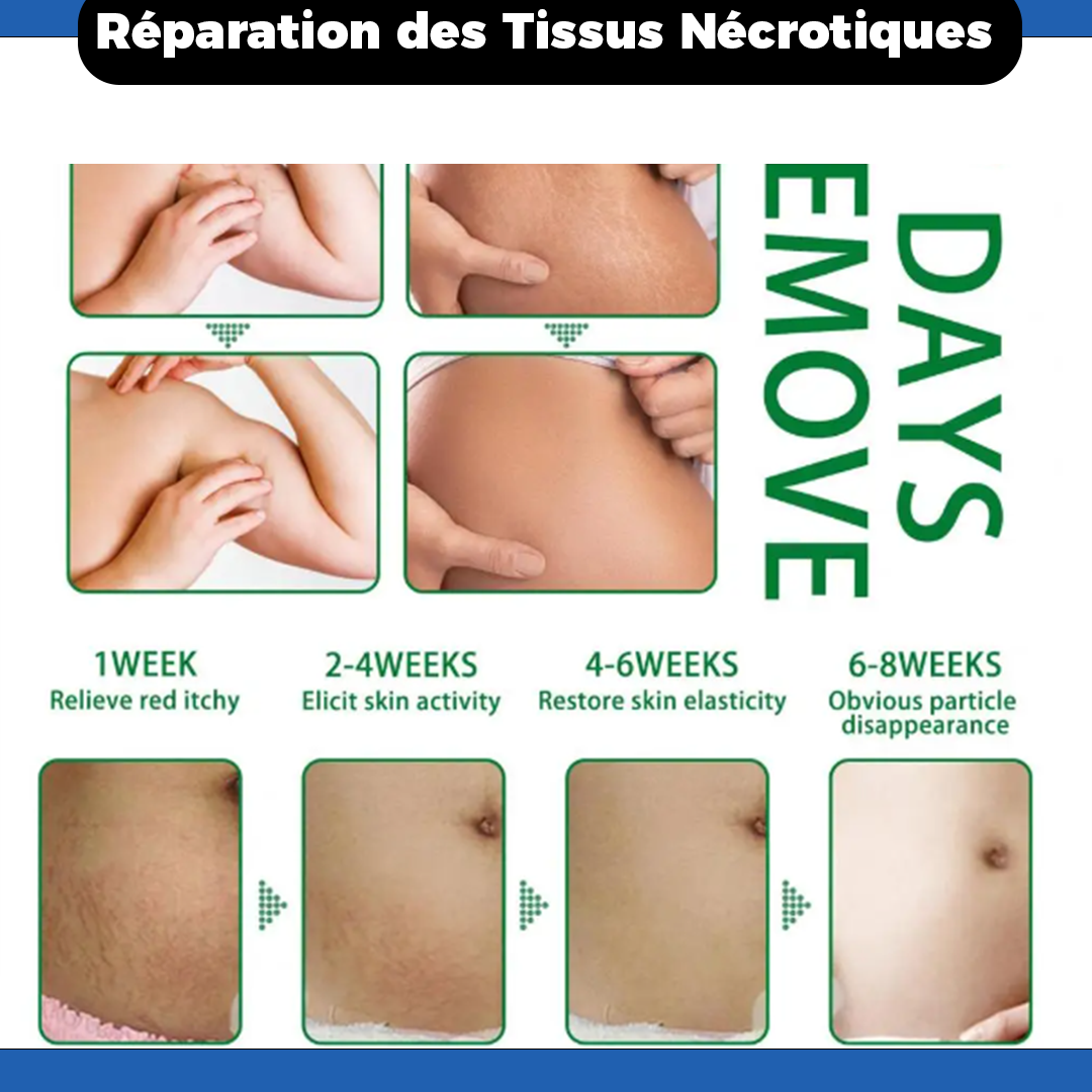 Crème Anti-Vergetures – Solution Réparatrice Premium